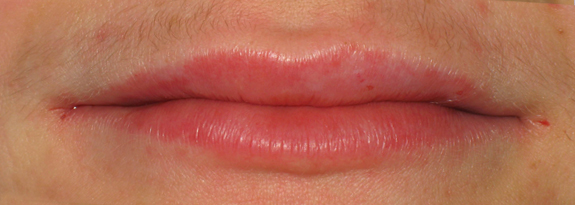 Lipofiling