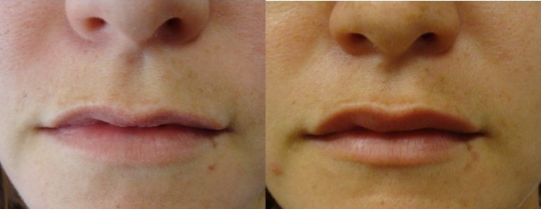 Lipofilling