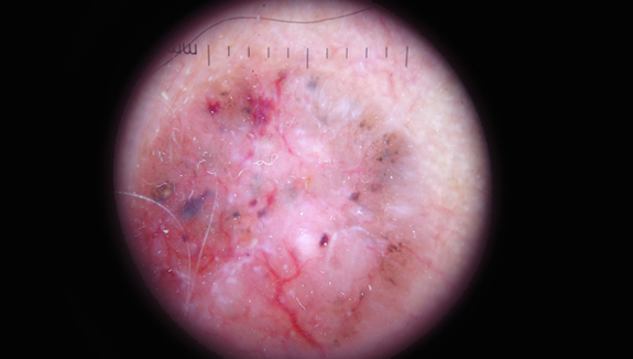 Dermatoscopy
