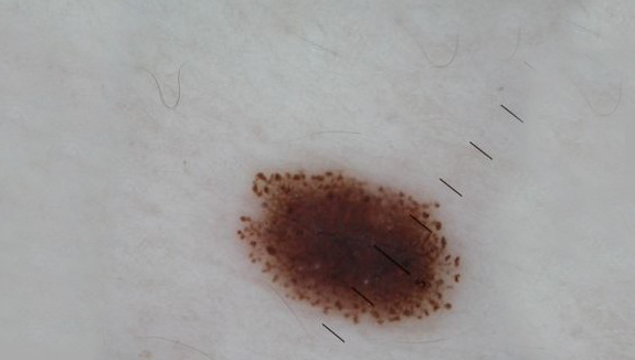 Dermatoscopy