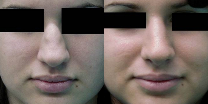 Rinoplastika
