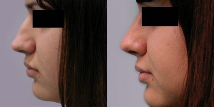 Rhinoplasty