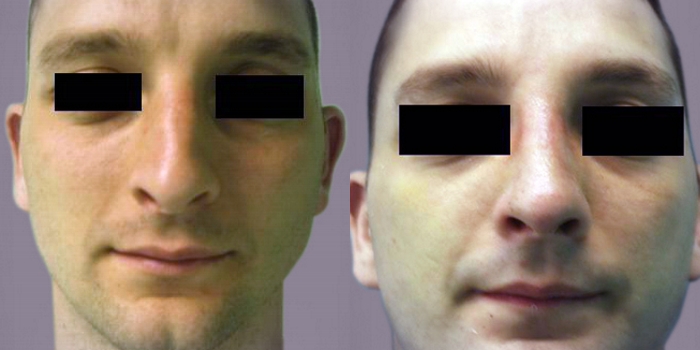 Septorhinoplasty