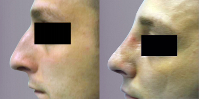 Septorhinoplasty